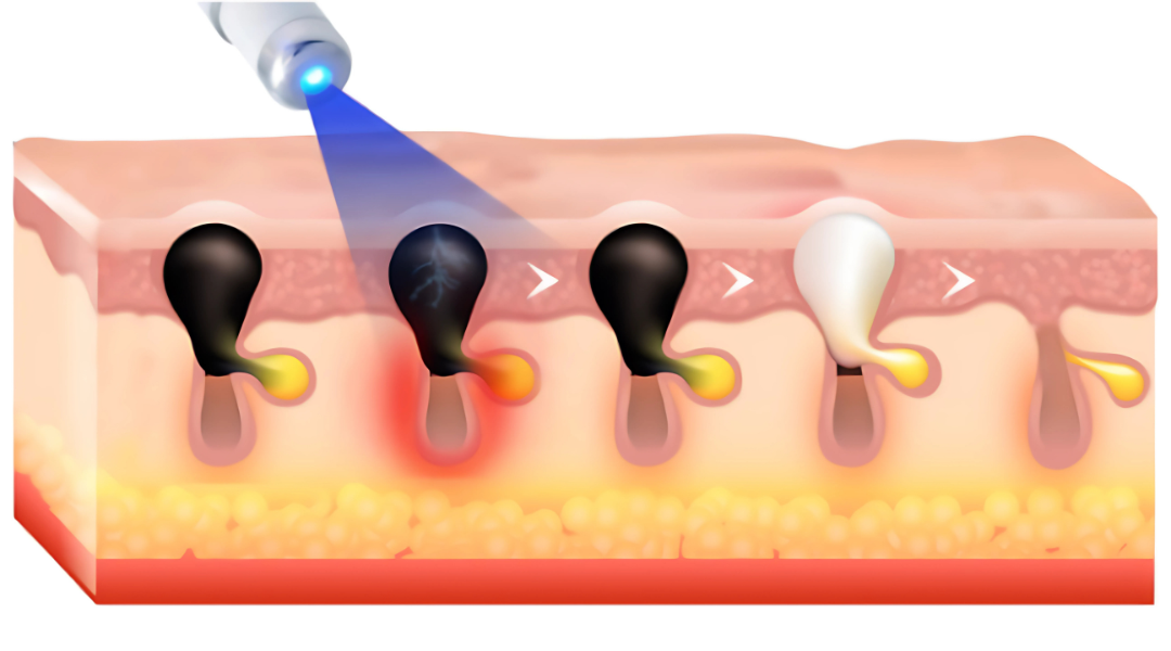 DEFELIA® Laser Penn- Penna rimuovi imperfezioni