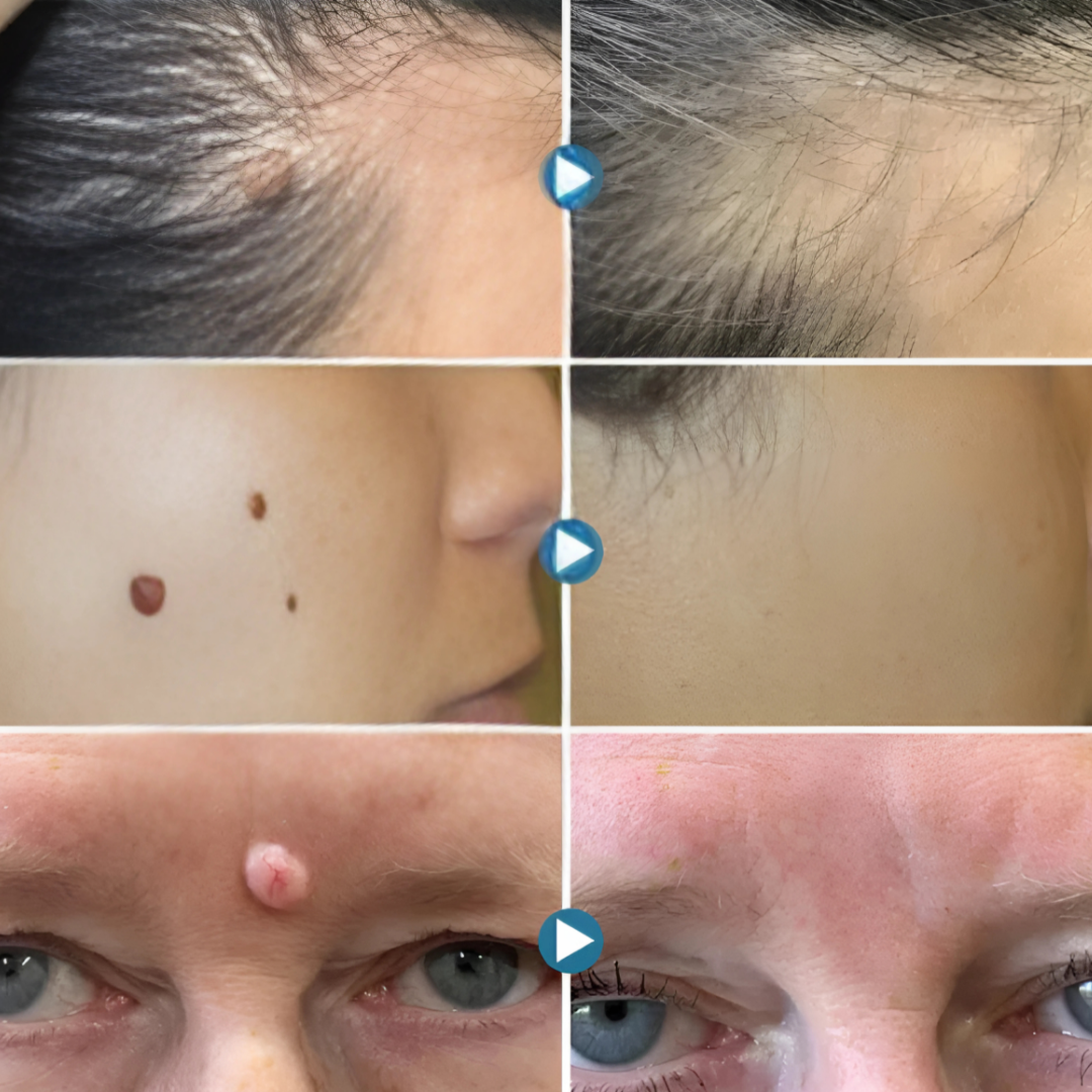 DEFELIA® Laser Penn- Penna rimuovi imperfezioni