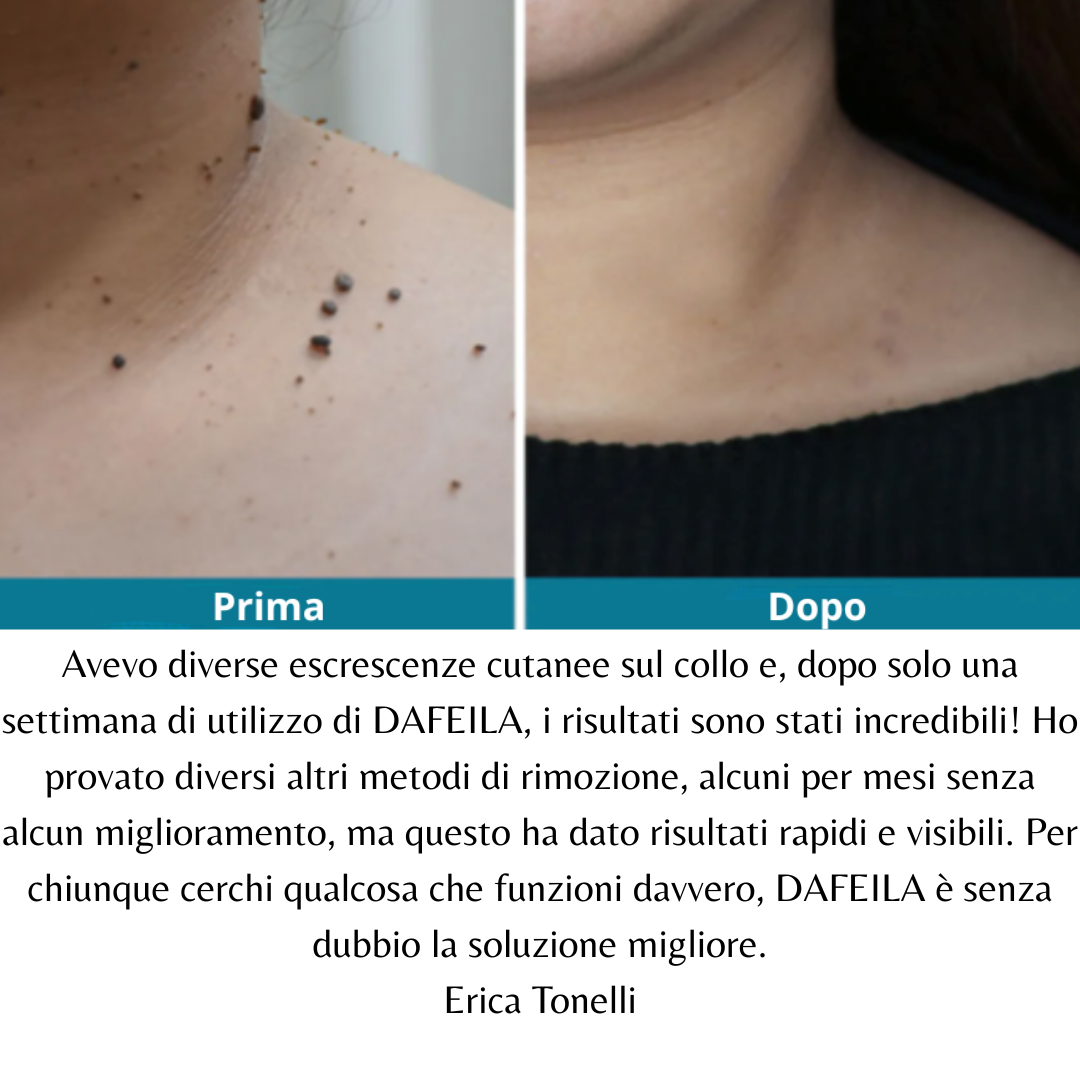 DEFELIA®  Laser Penn- Penna rimuovi imperfezioni