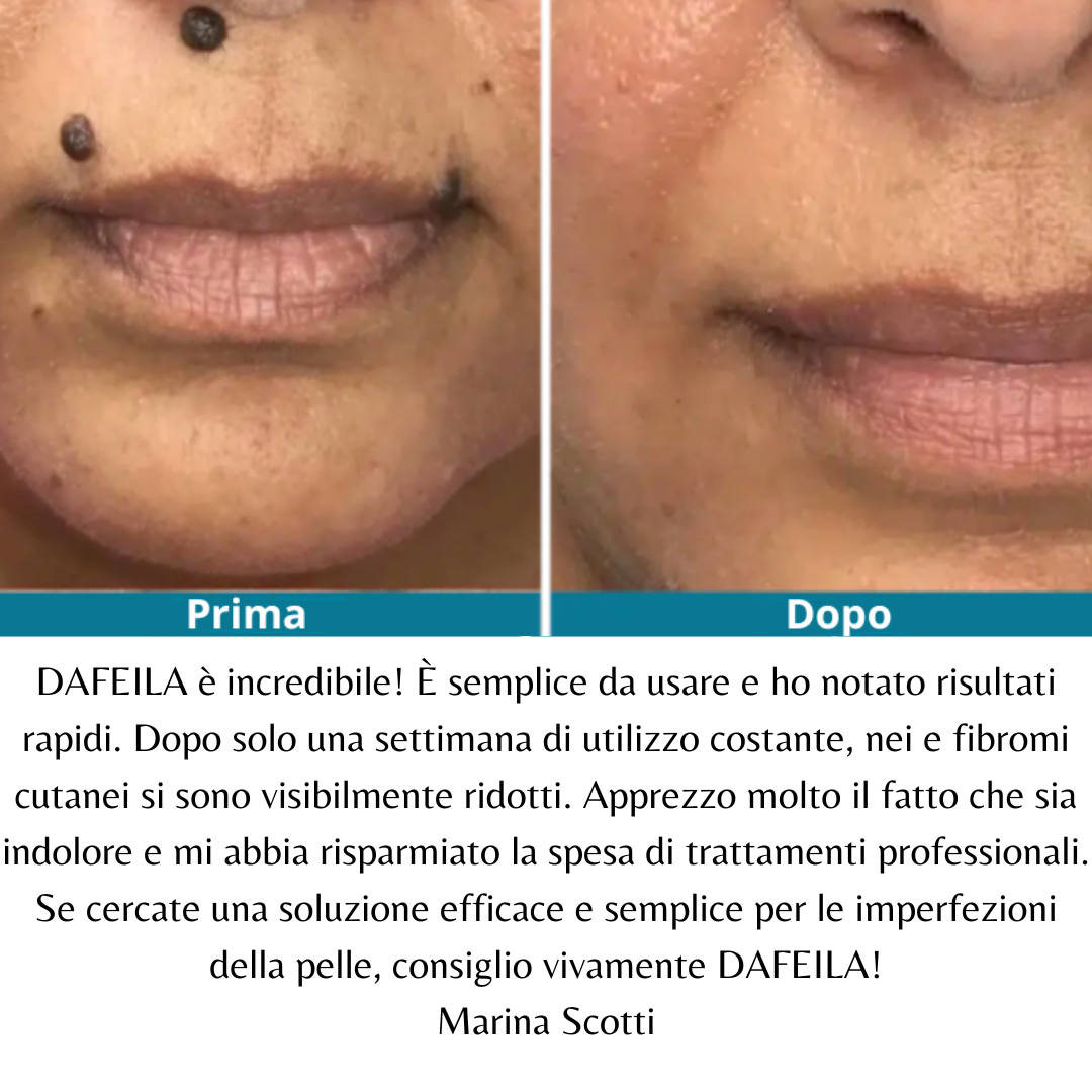 DEFELIA®  Laser Penn- Penna rimuovi imperfezioni