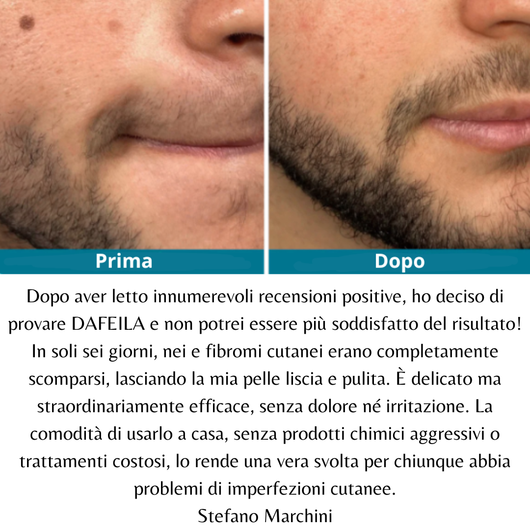 DEFELIA®  Laser Penn- Penna rimuovi imperfezioni