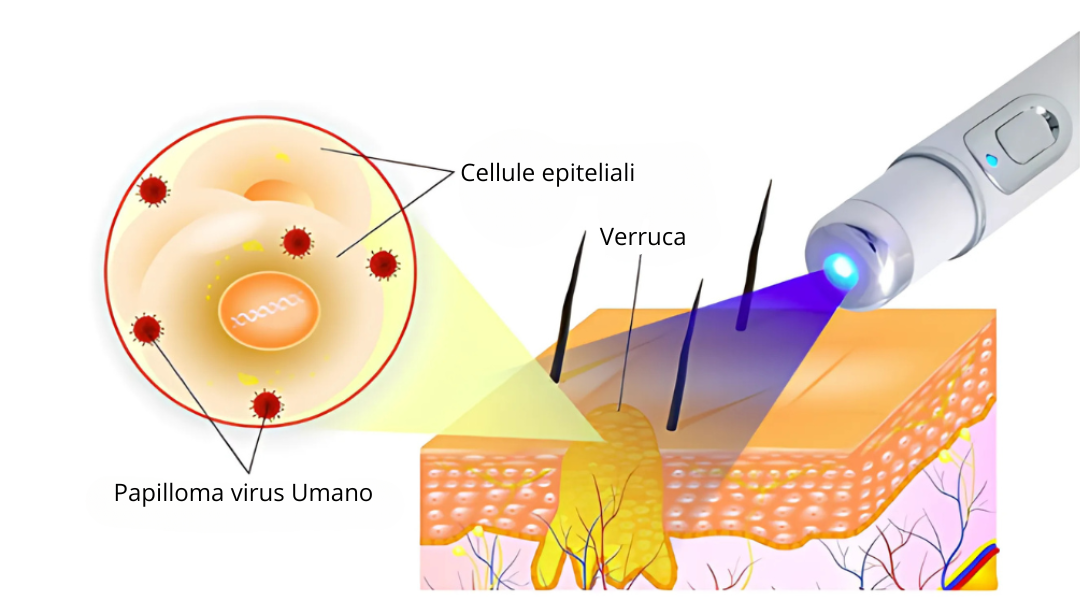 DEFELIA®  Laser Penn- Penna rimuovi imperfezioni